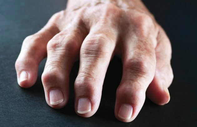 Rheumatoid Arthritis